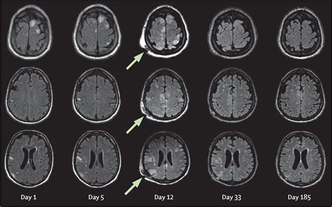 Anti Gabaa Receptor Encephalitis 14 Months After Allogeneic Haematopoietic Stem Cell Transplant