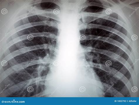 Torax X-ray Image Stock Photography - Image: 1002792