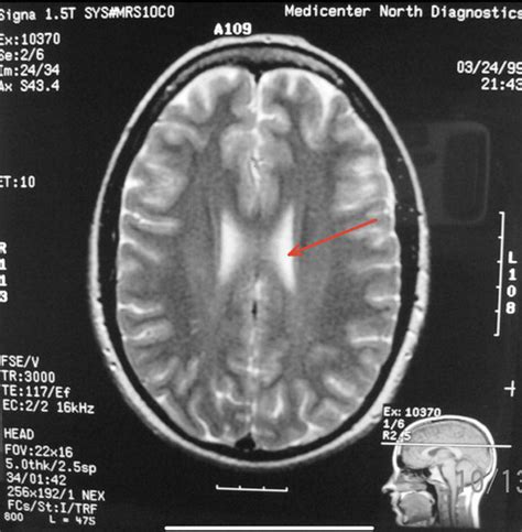 Human Sectional Anatomy Brain Part 1 Ventricular And Cisternal