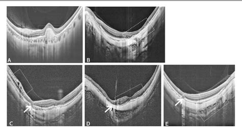 Figure 1 From Macular Bruch S Membrane Defects And Other Myopic Lesions In High Myopia