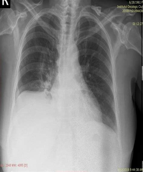 A Standard Chest X Ray In The Incidence Of Posterior Anterior