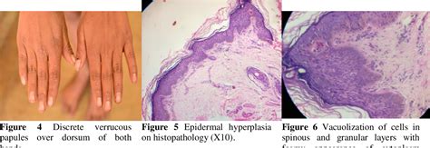 Figure 6 From Epidermodysplasia Verruciformis A Rare Case Presentation