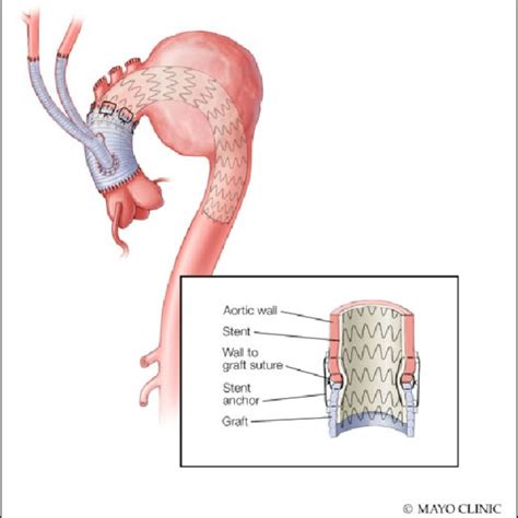 Illustration Of Hybrid Open Endovascular Repair Of The Contained