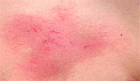 Heliotrope Rash Inside The Clinic