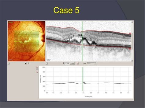 How 3 d oct enhances amd & dme treatment