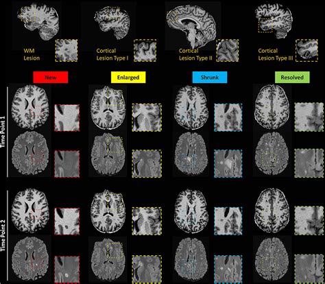 Frontiers Evolution Of Cortical And White Matter Lesion Load In Early