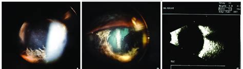 Anterior Uveitis Flare Cells