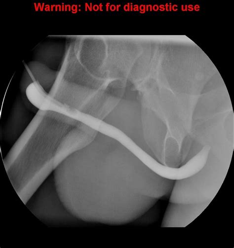 Normal Retrograde Urethrogram Rug And Voiding Cystourethrogram Vcug Radiology Case