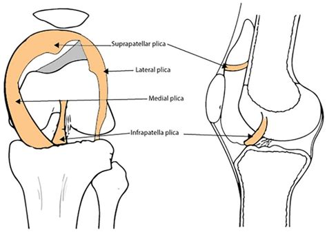 Plica Knee Condition | David Slattery