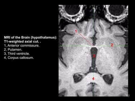 Mri Imaging Hypothalamus Dr Ahmed Esawy Ppt