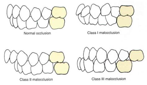 Angles Classification Dentalnotebook