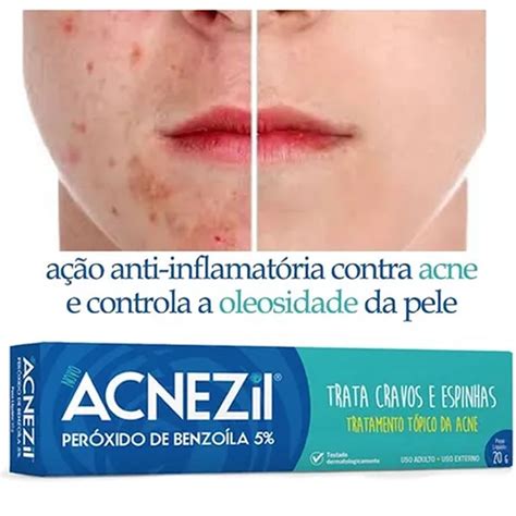 Kit Acnezil Gel G Cravos Espinhas Vitacid Secativo Tubos Submarino