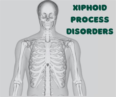 Xiphoid Process Disorders Anatomy Causes Symptoms And Treatment Options