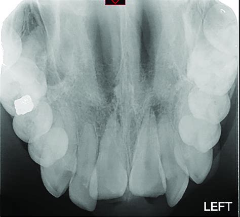 Standard Maxillary Occlusal Radiograph Identifying Apical Displacement