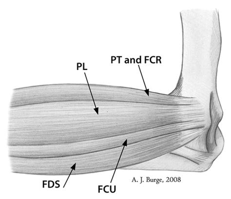 Treatment Of Recalcitrant Lateral Epicondylitis With Suture 60 Off