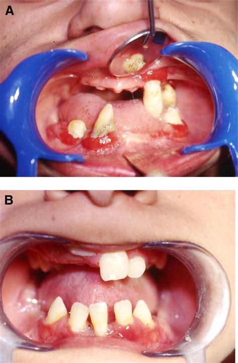 Papillon Lefevre Syndrome Clinical Presentation And A Brief Review