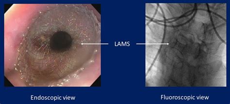 Lumen Apposing Metal Stent LAMS Across An Anastomotic Stricture