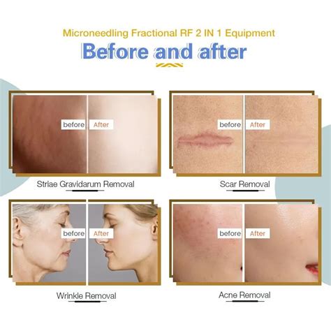 2 In 1 RF Microneedling And Collagen Induction Machine For Skin