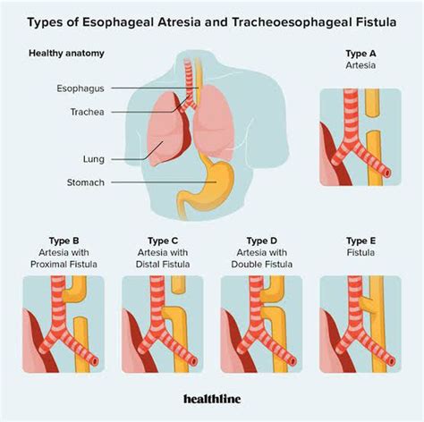 Esophageal Atresia And Tracheoesophageal Fistula Medizzy