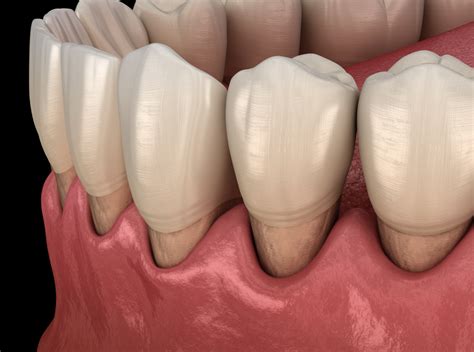 Cómo regenerar encías retraídas Estudi Dental Barcelona