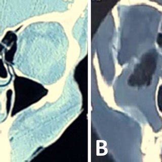 Coronal CT scan of the NPS (A) large left Concha bullosa and the ...