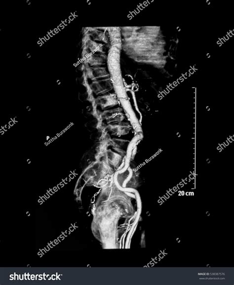 Computed Tomography Angiography Cta Abdomen Pelvic Foto Stock 538387576