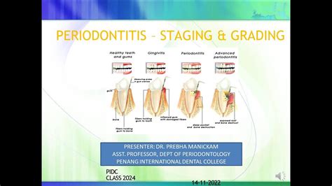 PERIODONTITIS STAGING GRADING YouTube