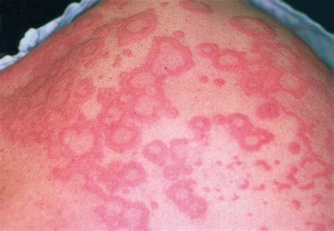 Erythema Multiforme Associated With Bupropion Use Dermatology Jama Internal Medicine Jama