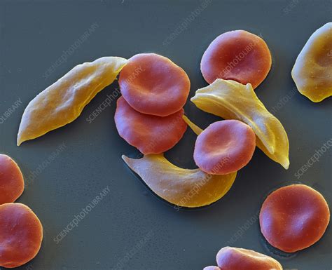 Sickle Cell Anaemia Sem Stock Image C058 0937 Science Photo Library