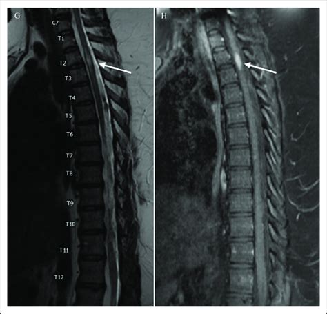 Legend G And H Mri Of The Thoracic Spine T Weighted Sagittal