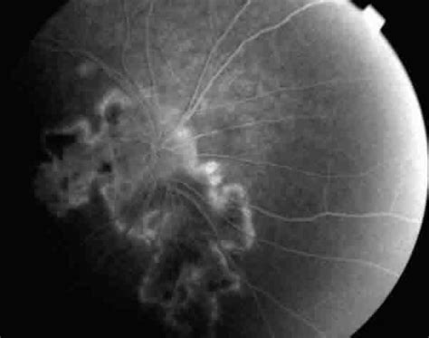 Fig 3 Angiografía fluoresceínica del ojo derecho tiempos tardíos