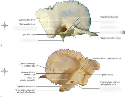 Temporal Bone Diagram Quizlet