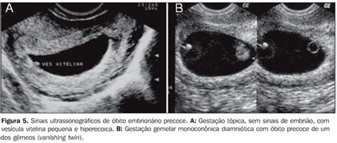 Gravidez Anembrion Ria Papo Mulherio