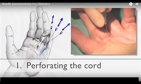 Needle Aponeurotomy For Dupuytrens Disease —