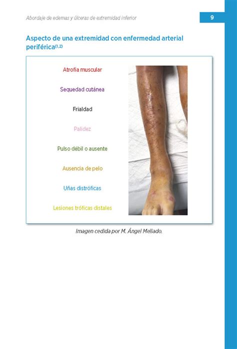 Abordaje de edemas y úlceras de extremidad inferior Ergon