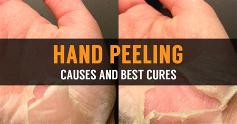 Reasons For Skin Peeling On Hands Home Easy Natural Remedies