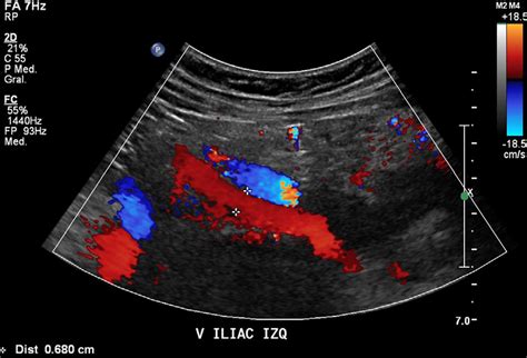 Ecotomograf A Doppler Color Venosa De Extremidades Inferiores Donde Se