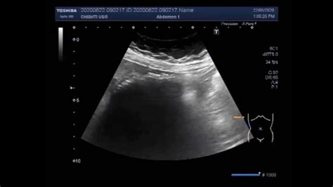 Ultrasound Video Showing Multiple Small Gall Bladder Stones With