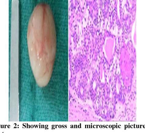 Figure 1 From PLEOMORPHIC ADENOMA OF MINOR SALIVARY GLAND OF CHEEK A