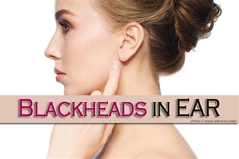 To get rid of blackheads in ear fast, naturally and permanently, try on ...