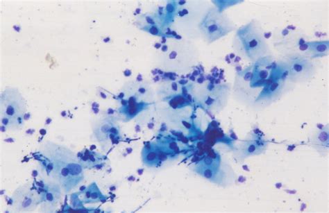 Conventional Smear Fungi Infection Papanicolaou Stain ×200