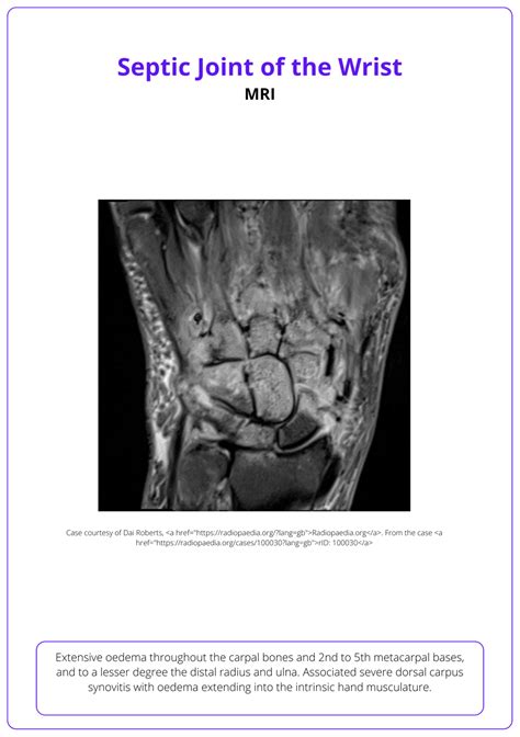 Septic Arthritis Of The Hand Causes Diagnosis Treatment