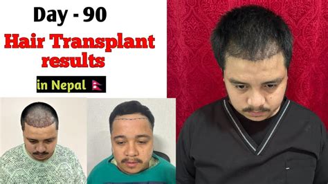 Day 90 My Hair Transplant Results Hair Transplant In Nepal Rabin