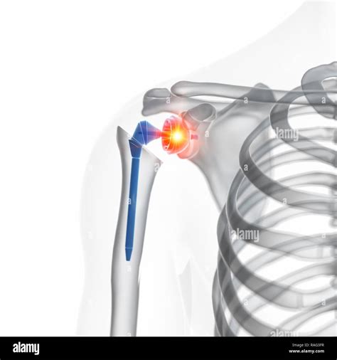 Schultergelenk implantat 3d Fotos und Bildmaterial in hoher Auflösung