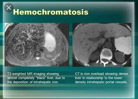 Pin By Liznel Feliberty On Imagenes De Ct Scan Y Mri Radiology Mri