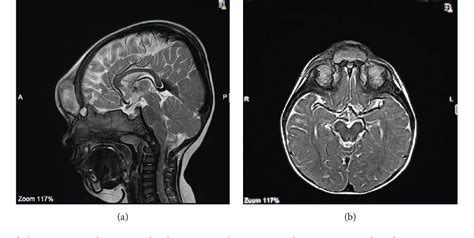 Figure 1 From An Intracranial Extradural Dermoid Cyst Presenting With