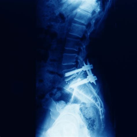 Lateral Lumbar Interbody Fusion Xlif And Llif Texas Spine Care Center