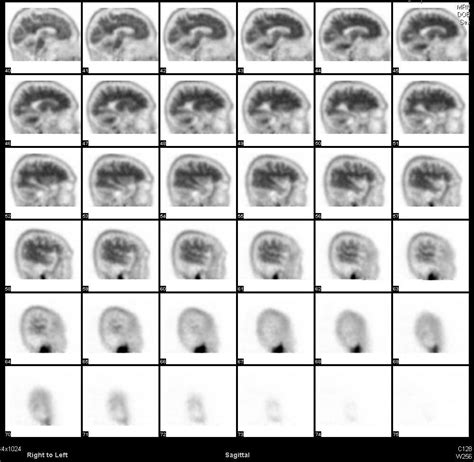 Pet Brain Amyvid Scan