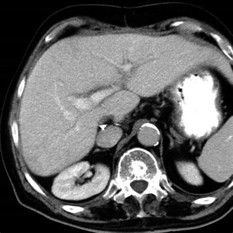 Hepatic Transplantation Radiology Key