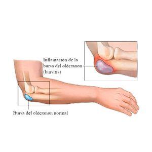 Bursitis Olecraneana Dr Gustavo Armando Tafoya Arreguín